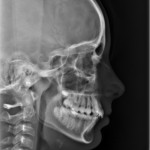 Röntgen met kaak als voorbeeld van de orthodontie behandeling.