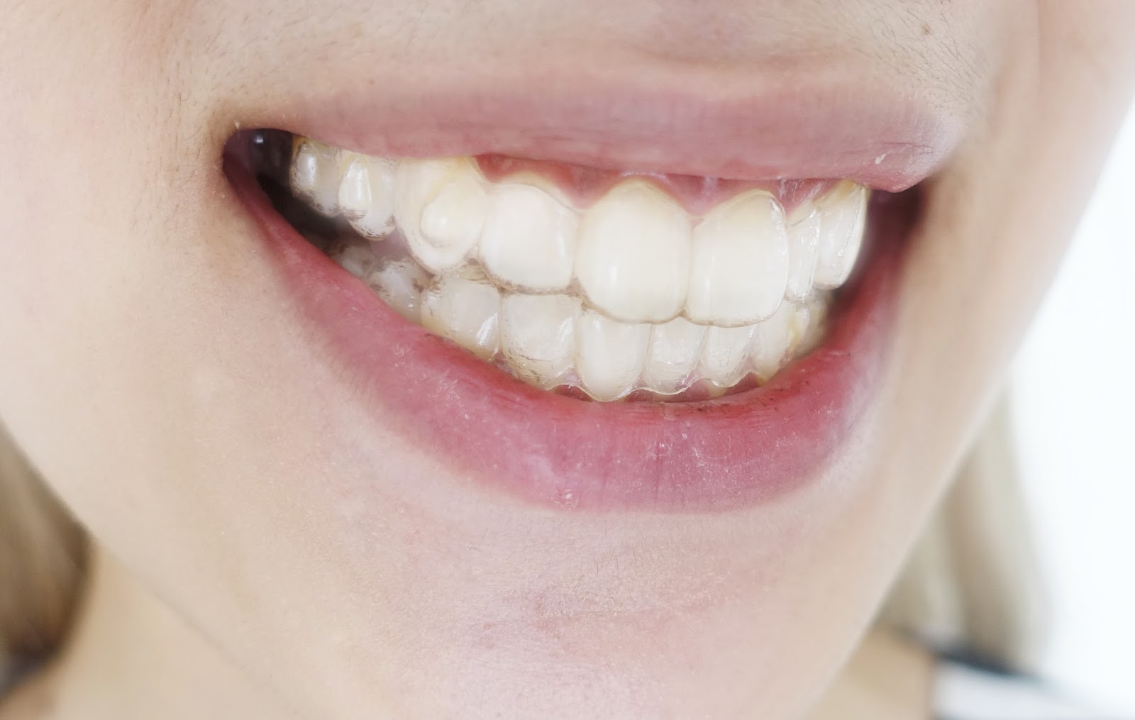 volgens Verklaring exotisch Onzichtbare Beugels – Orthodontist Hereplein