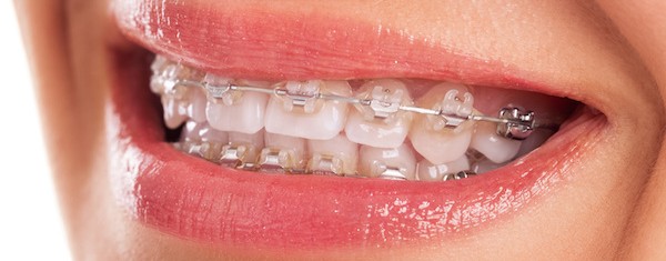 baseren plein Ontoegankelijk Onzichtbare beugels – Orthodontist Hereplein