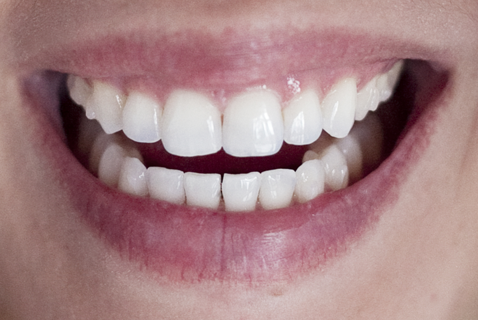 Onzichtbare – Orthodontist Hereplein