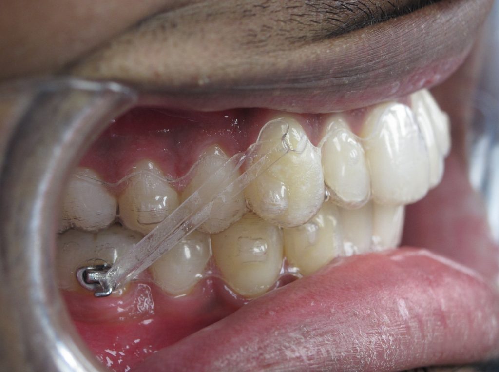 LIKERAINY 0-90-180 Graden Vouwscharnier Extensie Vergrendelen Opvouwbare Onzichtbare Beugels voor Tafelverlenging Paneel Meubels Bedden Kledingkast Planken Ondersteuning Zilver 4 Stukken