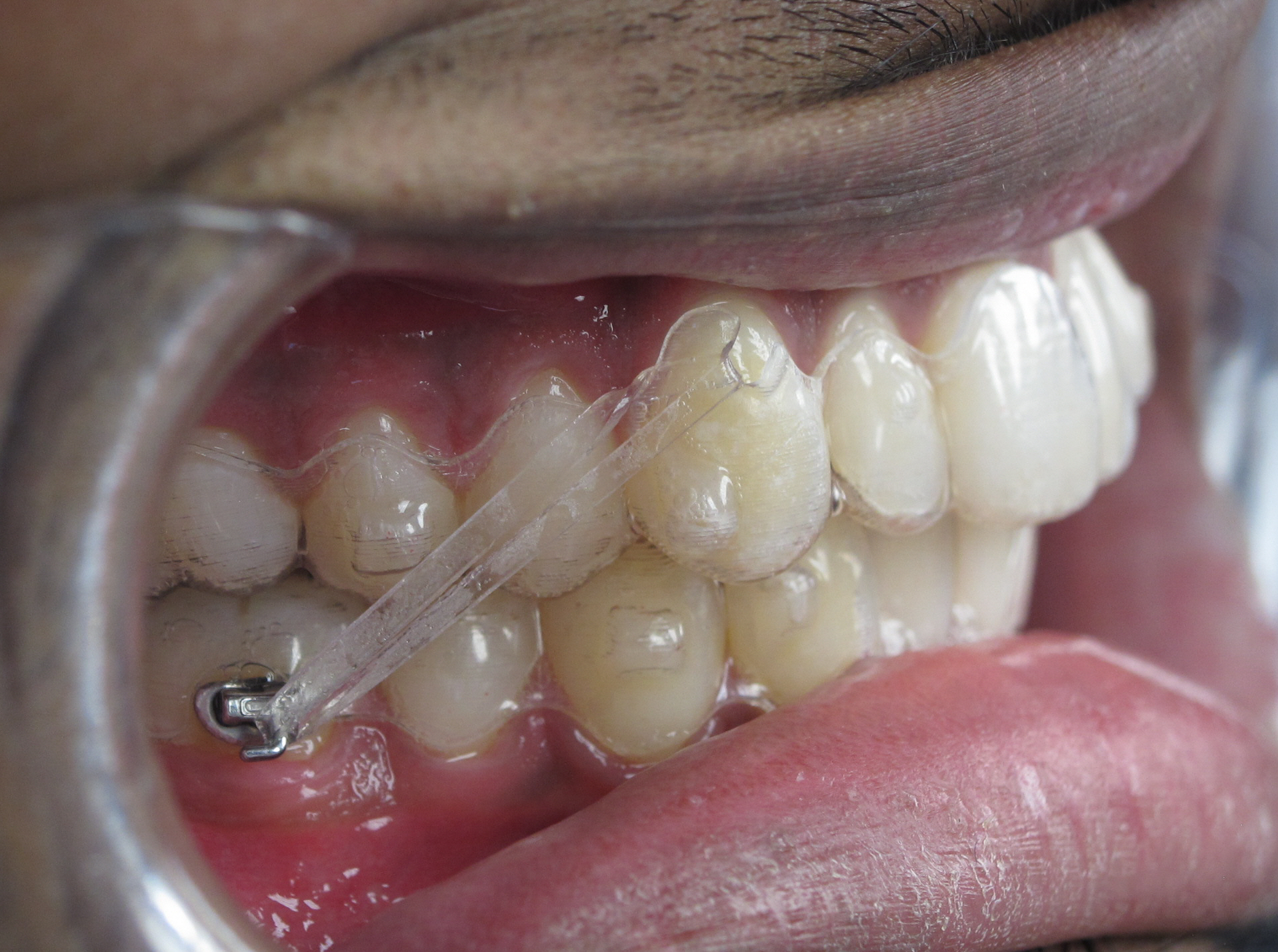als je kunt Afrekenen Neem een ​​bad Onzichtbare Beugels – Orthodontist Hereplein